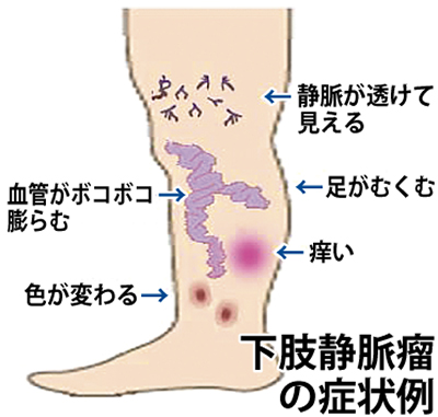 足の血管の病気