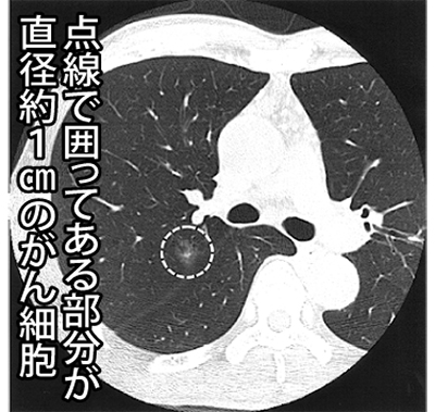 低線量に抑えられた肺がんＣＴ検診について