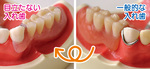 隣の歯にバネを掛ける一般的な入れ歯。金属部分が目立つ（右）／歯肉と同じ色のバネを使用するため、目立ちにくい（左）