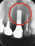 インプラント埋入後の前歯