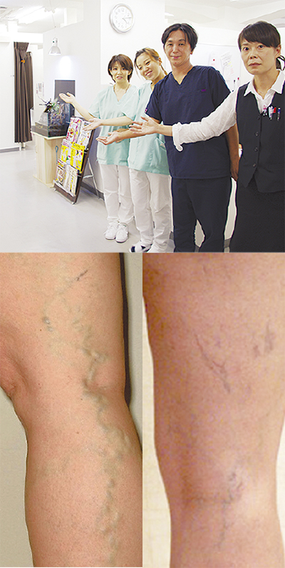 足の静脈瘤を日帰り手術