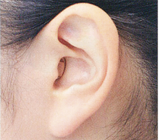▲小さく目立ちにくい「耳穴式」補聴器も人気