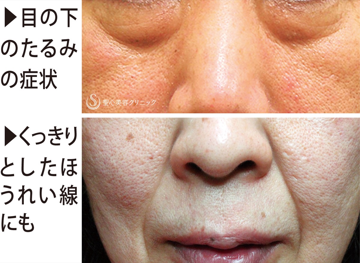 ｢自分の血液｣を使ったシワ治療法 (写真3)