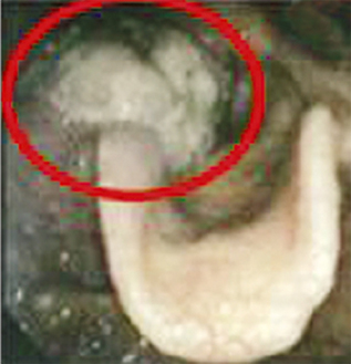 下咽頭がん。声帯温存で消滅した症例も紹介
