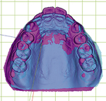 治療前（ピンク）と治療後（青）の歯型をデジタル化して重ね合わせ、歯の移動状況を確認する。