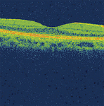 ＯＣＴ画像による網膜黄斑部の断面図