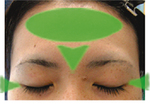 A型ボツリヌス毒素製剤注射が効きやすい箇所。額、眉間、目尻など。