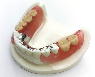 ひっかける金属が目立たない入れ歯（保険適用外・自費義歯）