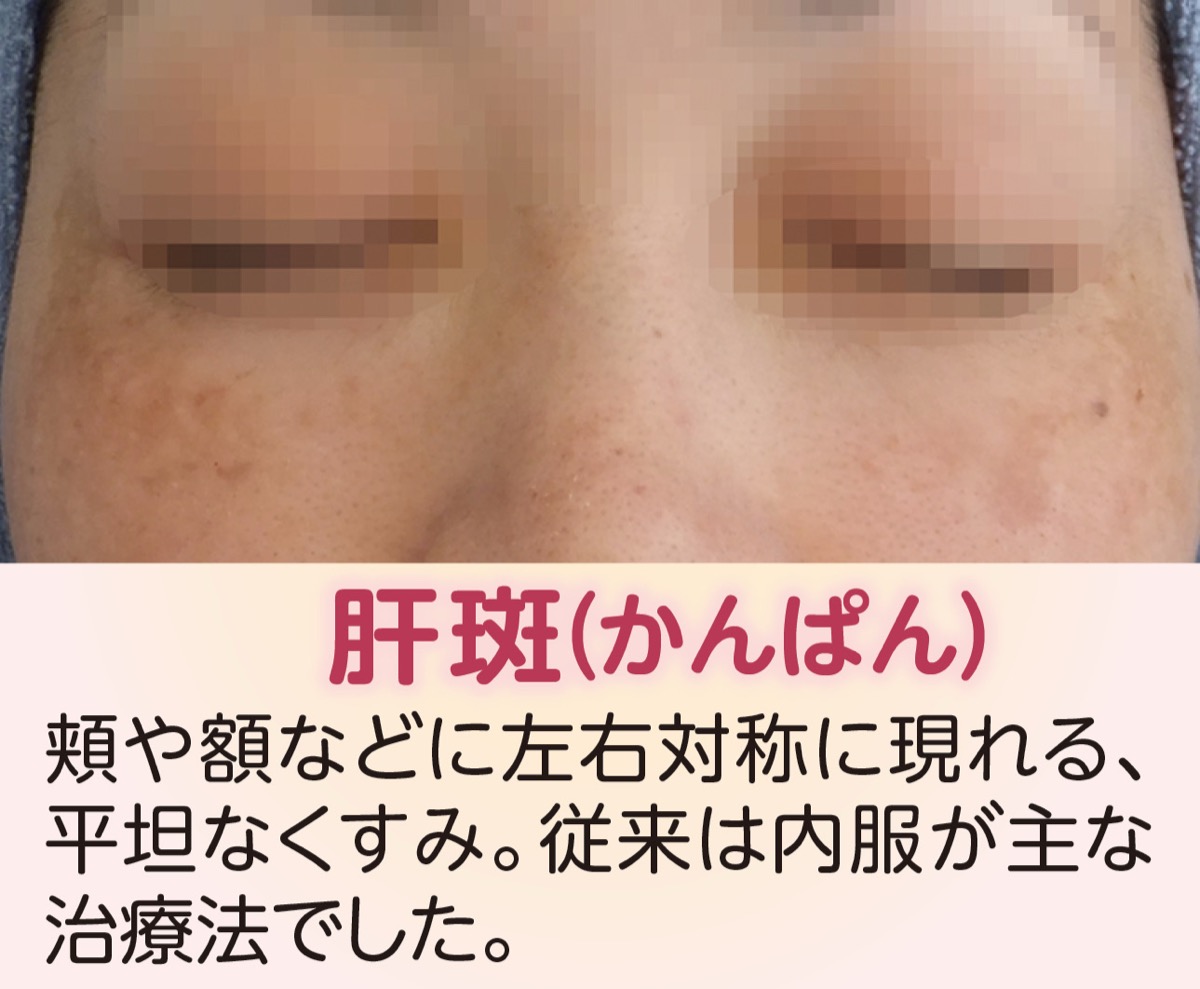 気になる「肝斑(かんぱん)」を改善 (写真2)