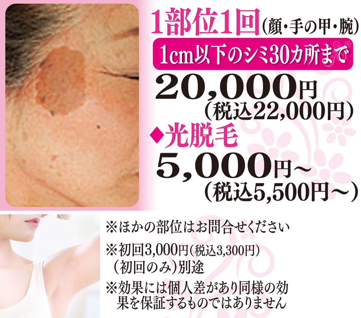 シミ取り放題 光脱毛スタートは今がベスト | 海老名・座間・綾瀬