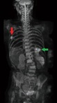 全身ＭＲＩ検査の撮影写真。赤矢印が肺癌、緑矢印は炎症性変化（厚木佐藤病院提供）