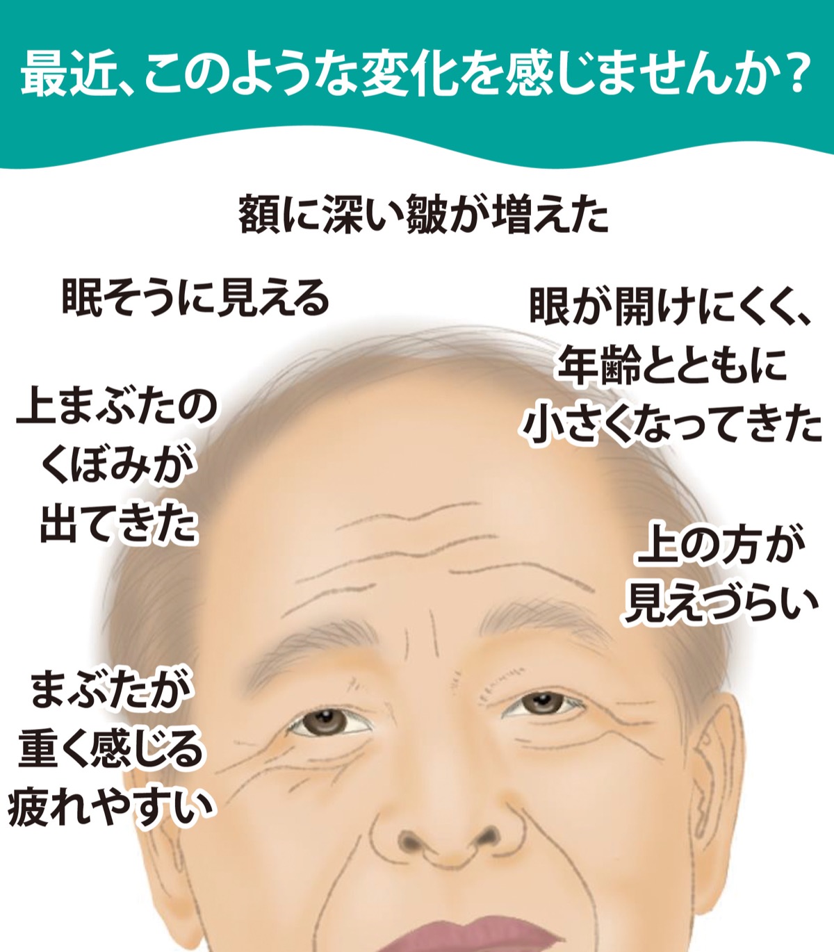 日常に支障きたす眼瞼下垂 (写真1)