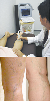 超音波検査の様子（上）と膝裏の症例写真