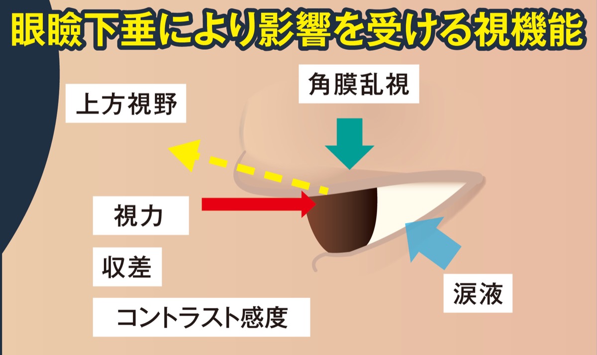 目のお悩み相談室「眼瞼下垂とは」 (写真2)