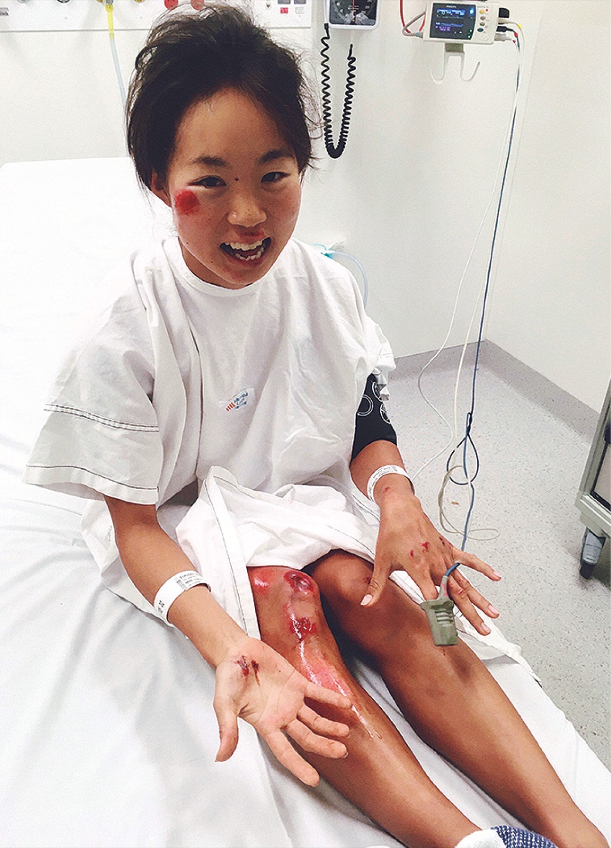 ２月の練習中、時速52Kmのスピードで事故に遭い搬送。これから正念場という時だった（福岡さん提供）