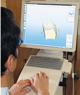 専属の歯科技工士が修復箇所を即座に３Ｄデータ化。削った歯に合わせ、その場でセラミックを削り出す
