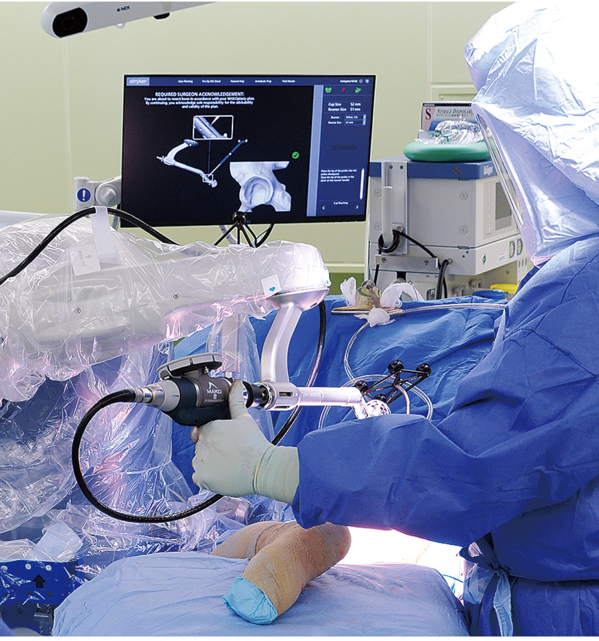 手術ロボで精度向上関節置換術サポート