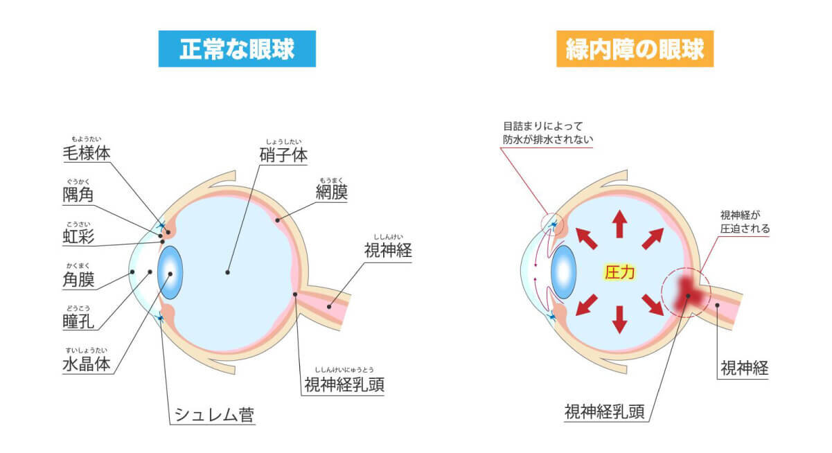 正常な眼球と緑内障の眼球を比較した図